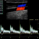 stenosis 이미지