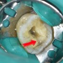 조용민치과의원 | 씹을 때 찌릿! 단단한 음식을 조심하지 않으면 이렇게 됩니다.