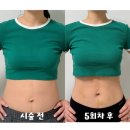 영영사 | 상상이 현실이되는 의원, 날씬한 허리라인을 상상하며 방문한 대전 복부지방분해주사 5회차 후기
