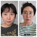 꽃보다 멍 | 압구정역피부과에서 받은 울쎄라 리프팅 300샷 멍,붓기,효과,가격 후기