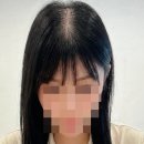 참바른약국 | 함익병 탈모크림 탈모제 효과 가격 바르는법 내돈내산 후기