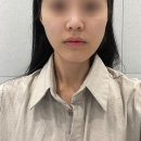 교선한의원 | 신사역 한의원에서 턱 비대칭교정 매선받고 왔어요!