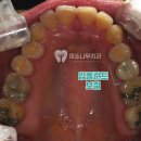 화서역치과 임플란트 통증 일으키는 ‘이것’