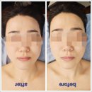 일산피부관리 5D프리미엄 턴업관리 솔직후기