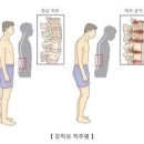 척추 마디가 굳는 강직성 척추염 이란? 증상 원인 치료 방법 이미지