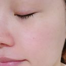 아이멍 | 내돈내산-&gt;아이리쥬란 후기 멍,통증,붓기(1일차~10일차 비교)