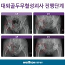 대퇴골두 무혈성괴사 원인, 고관절 통증, 고관절 인공관절 수술 후 재활까지 걸리는 시간은??,인공관절수술잘하는곳 이미지