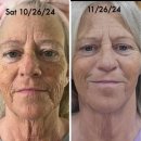 바른윤곽치과병원 | 바르는필러! 네오필