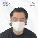 은평-010 | 일산 SMP 메이두 상담, 시술, 관리까지 솔직 후기
