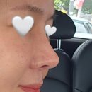 현성의원 | 그날성형외과 후기, 코재수술 복코
