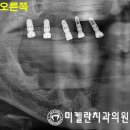 "틀니 불편해요" 강남치과 미켈란 에서 전체 임플란트 수술 로 구강 개선