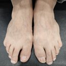 진병원 | 이천 발톱무좀 내성발톱 무좀병원에서 관리받고 좋아진 후기