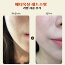 메디솔루션 | 트러블피부관리 필수| 메디옥실 레드스팟 5.3%솔루션 내돈내산 , 관리효과