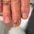 화정3층약국 | 손톱 검은줄, 곰팡이일까? 손톱무좀 증상 - 레푸스 화정점