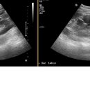 renal cyst 이미지