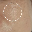 NO.1 자동차피부과 | 청담피부과 ECM 스킨부스터 "아디떼" 효과, 모공축소 전후사진ㅣ 솔직후기