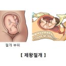 Cesarean section 이미지