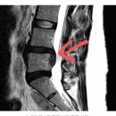 일독한의원 | 허리디스크 파열 보존치료 후기 (파열 2개월 후, 파열 1년 후, 파열 4년 후)