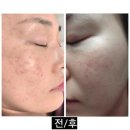화이트크리닝 미장1호점 | 검단 김포 피부 기미 비비드엘 추천 잡티 색소케어 미백관리 받은후기(전후사진)