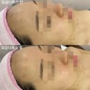 송파피부관리 올가드림뷰티 송파위례점ㅣ모공디톡스 1회로 바로 효과 보기
