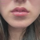 닥터고운선의원 | [강남/압구정] 닥터고운선의원 입술필러 일주일차 찐 후기 (필러통증, 압구정 입술필러)