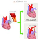 혈전용해치료비Ⅱ(감액기간 미적용)(통합간편가입)보장 특별약관[뇌졸중, 특정심장질환] 이미지