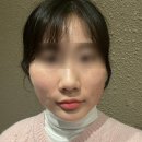 디룩 | 얼굴지방분해주사 3회차 심부볼 윤곽주사 전후 내돈내산 강남피부과 후기 (효과, 멍, 통증, 가격)