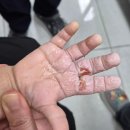 광개토병원 | 밥솥 증기 아기 손가락 2도 화상 치료, 수원 신세계외과의원, 대구 푸른 병원, 망포 새솔의원 치료 후기