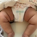 서울석병원 | 18개월 아기다리모양 발목 휨 다리주름 비대칭 서울석병원 (딤플재확인까지..)