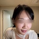 자인중학교 | 콧볼보톡스 후기 1주차 (콧볼 넓은 코라면? 코지방분해주사 같이 맞아 본 솔직 변화)