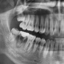 UR(원주시)-[신지정로]-하-9 | 원주 기업도시 사랑니 발치는 어디에서? 서울플란트...전문의 책임진료...사랑니 발치 방법 모음/후기/리뷰