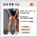 옥산제일정형외과의원 | 옥산제일정형외과 운동 후 갑자기 느껴진 통증, 인대 파열 신호일까?