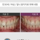 세종탑치과 네이버블로그