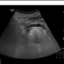 diffuse biliary tree dilatation and pancreatic ductal dilatation 이미지