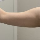 동작고려의원 | 신사지방분해주사 5회차 솔직후기 여름옷 핏 예뻐졌어요 신사제로의원