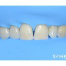 메일빈 (mail bean) | 앞니 블랙트라이앵글 레진 치료, 치아 삭제 없이 자연스럽게 메우기 위한 조건
