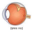 망막 정맥 폐쇄(Retinal vein occlusion) 눈 질환이란? 이미지