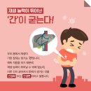 질병 "간경화 Liver cirrhosis " 이미지