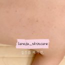 동양마트약국 | 노원 피부관리 라리쥬스킨케어 :: 등드름 자국 없애는 법, 등드름 관리 받고 왔어요