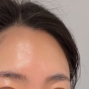 무통증 리프팅 효과 | 올라웨이브 • 볼뉴머 시술 후기