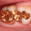 골드크라운 이미지