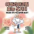 건강백세약국 | 아젤리아크림 효능, 여드름 자국 색소침착에 진짜 효과 있을까?