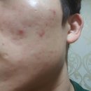 재생한의원 | 여드름흉터한의원 압출 재생 시술 솔직 후기