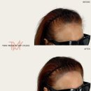 TMW 탈모왕수원 이미지