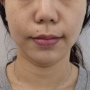 ​[반송동 피부관리] 역시 믿고 가는 동탄 윤곽맛집 '스킨스토리' 재방문 후기! (밸런스 얼굴관리)
