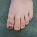 요푸네일(Yopuu nail) | (의정부 내성발톱) 내성발톱 참지말고 "NAIL by H"에서 해결해보아요.