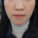 하루채 - 강서구 공항대로 222 | 내돈내산 동탄 쥬베룩볼륨 인디언밴드 리쥬란HB 통증 효과 솔직후기