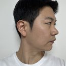 주식회사에이바이오 | [안산단원구피부과] 세렉소(celexo) 식물유래엑소좀 스킨부스터로 모공흉터치료 받은 후기 :)