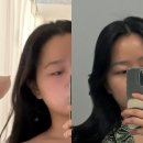 더웨이성형외과의원 | 강남에서 유명한 리프팅 강남역 온다리프팅 2회차 후기