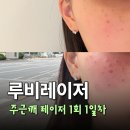 지성칼국수 | 일산 루비레이저 후기 주근깨 제거 고통은? 내돈내산 1일차